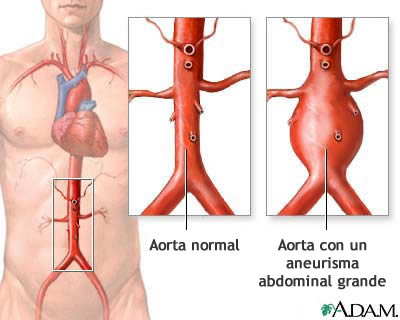 Aorta con un aneurisma abdominal grande Aorta normal