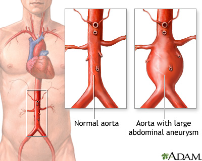 What abdominal aortic aneurysm looks like in the body. 
